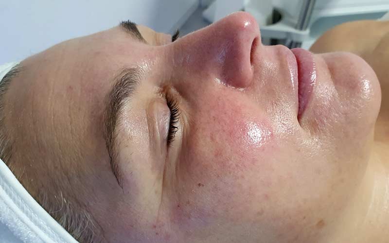 HydraFacial. Rosacea- Behandlung bei NiceFeet & Facial in Balingen. Vorher - Nachher Effekt
